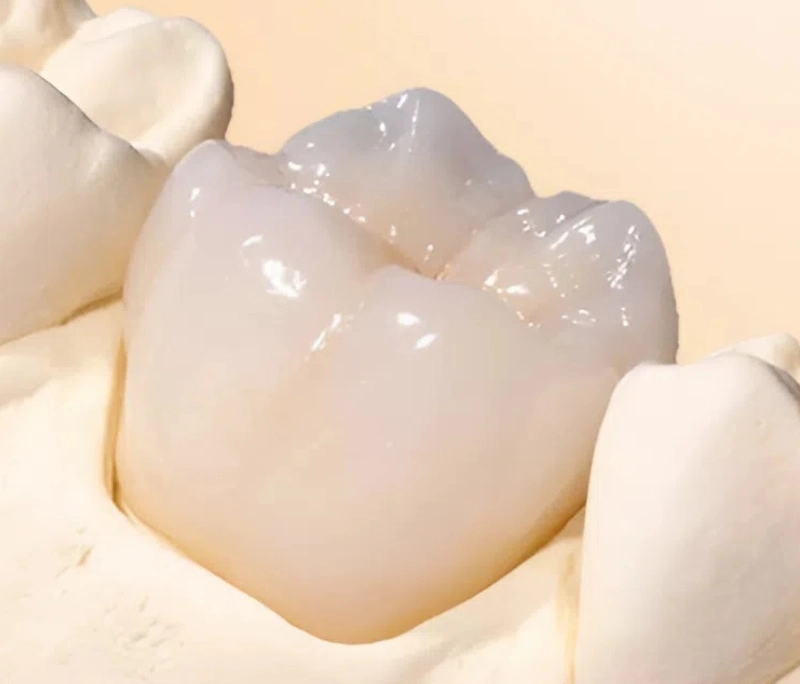 Bọc răng sứ 1 chiếc có được không? Giải đáp đáp chi tiết từ chuyên gia